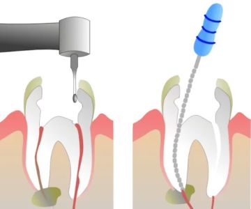 Understanding the Root Canal Treatment Process Step by Step