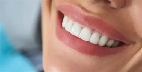 How to Whiten Teeth After Braces Safely and Effectively