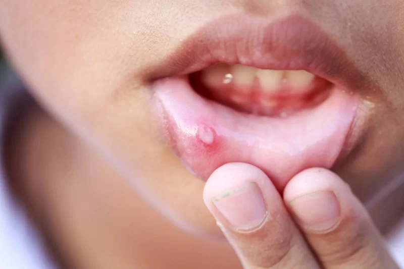 How to Treat Oral Ulcers Effectively at Home and with Professional Care