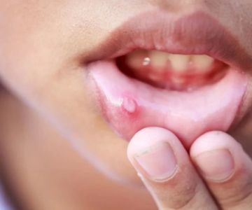 How to Treat Oral Ulcers Effectively at Home and with Professional Care