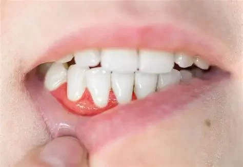 Signs of Gum Abscess and How to Recognize Them Early