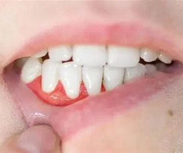 Signs of Gum Abscess and How to Recognize Them Early