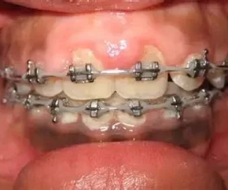 How to Prevent Gum Disease After Braces Removal and Care Maintenance