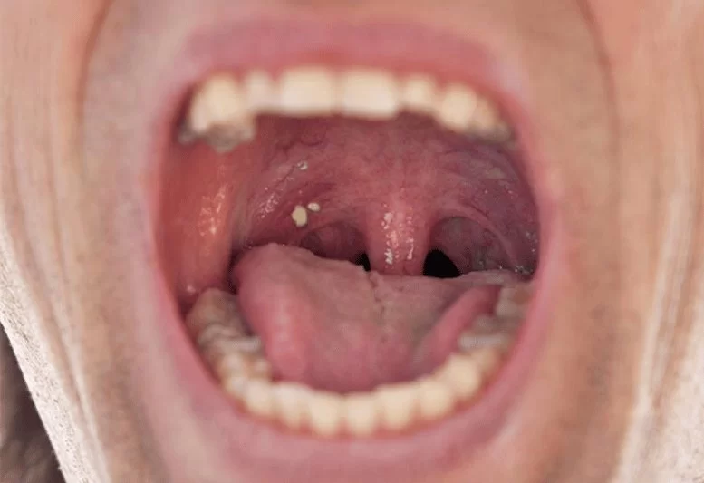 Do Tonsil Stones Mean Bad Oral Hygiene? Here's What You Need to Know