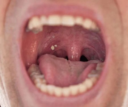 Do Tonsil Stones Mean Bad Oral Hygiene? Here's What You Need to Know