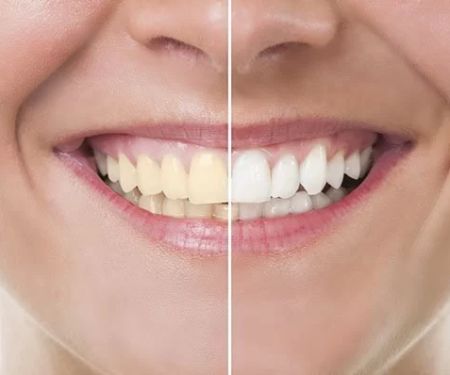 How to Fix Yellow Teeth Naturally at Home – Simple and Effective Tips