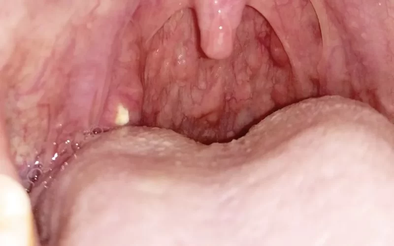 Can You Get Tonsil Stones with Good Oral Hygiene?