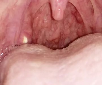 Can You Get Tonsil Stones with Good Oral Hygiene?