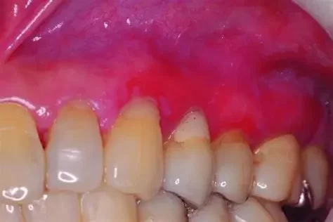 What Is Oral Lichen Planus Disease