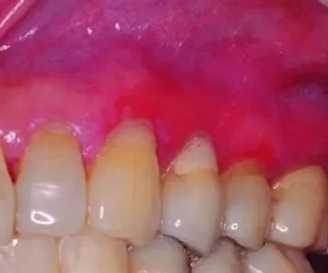 What Is Oral Lichen Planus Disease