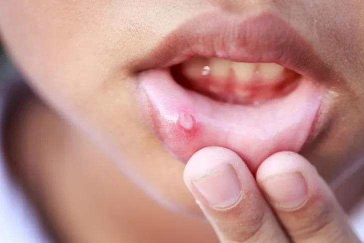 Signs of Oral HPV Infection and What You Should Know