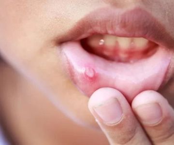 Signs of Oral HPV Infection and What You Should Know