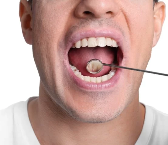 Signs of Oral Cancer Early Warning Signs and Detection Care