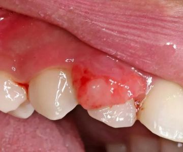Can Gum Disease Lead to Oral Cancer