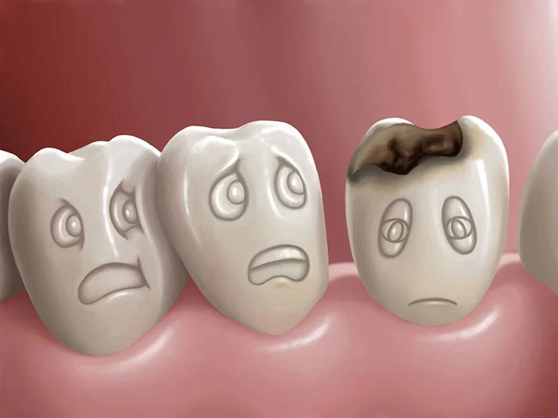 How to Prevent Tooth Decay in Teenagers and Adults with Practical Tips