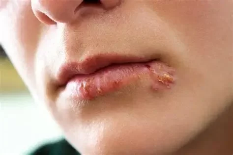 Signs of Oral Herpes Infection and Effective Management Strategies
