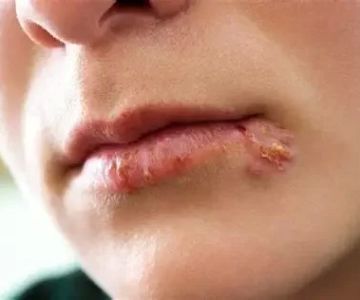 Signs of Oral Herpes Infection and Effective Management Strategies