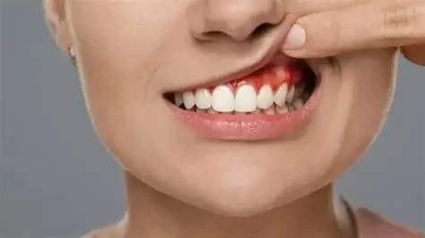 Signs of Tooth Abscess Pain Symptoms and How to Recognize Them