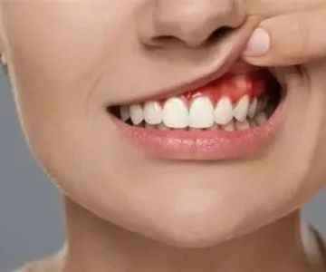 Signs of Tooth Abscess Pain Symptoms and How to Recognize Them