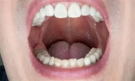Can Poor Dental Hygiene Cause Oral Thrush – Causes, Risks, and Solutions