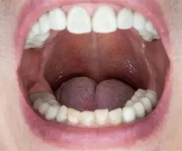 Can Poor Dental Hygiene Cause Oral Thrush – Causes, Risks, and Solutions