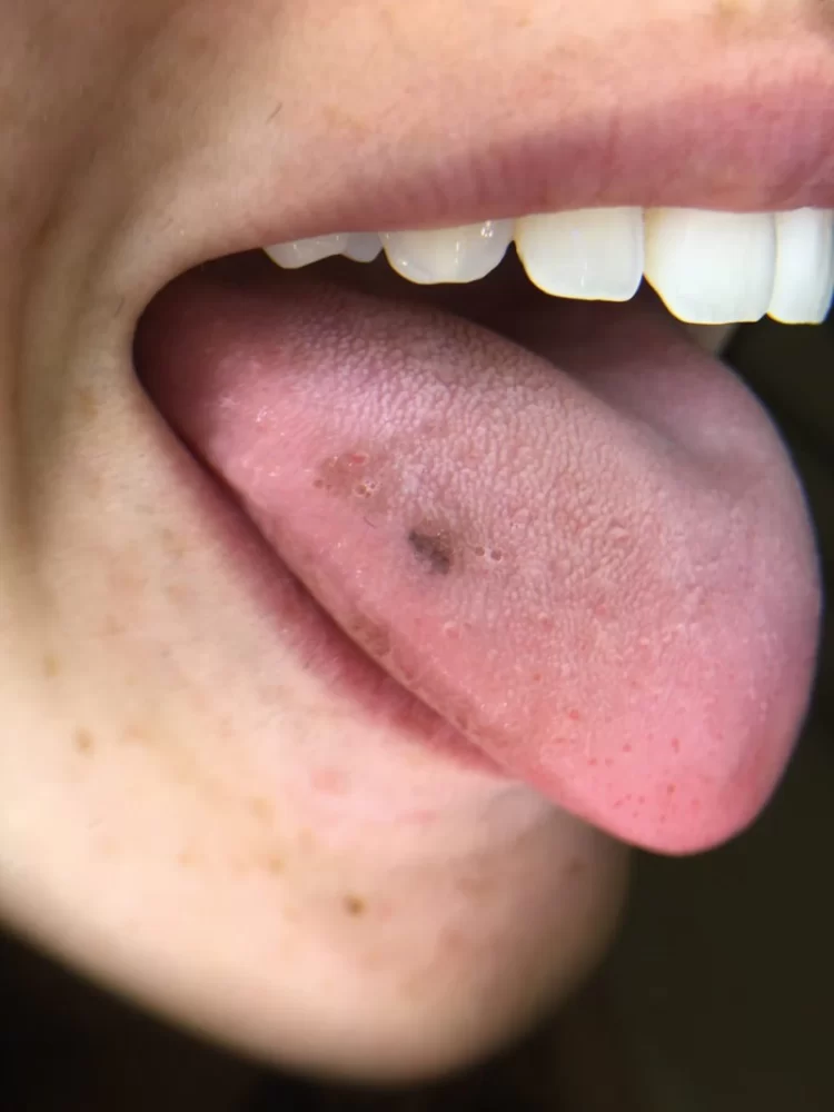 Causes of Black Spots on Tongue Related to Oral Health Issues