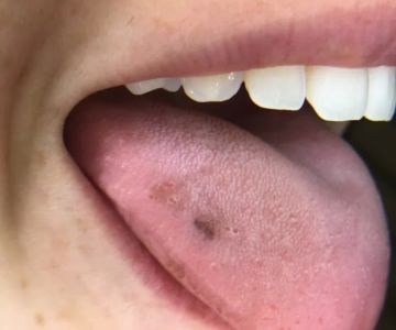 Causes of Black Spots on Tongue Related to Oral Health Issues