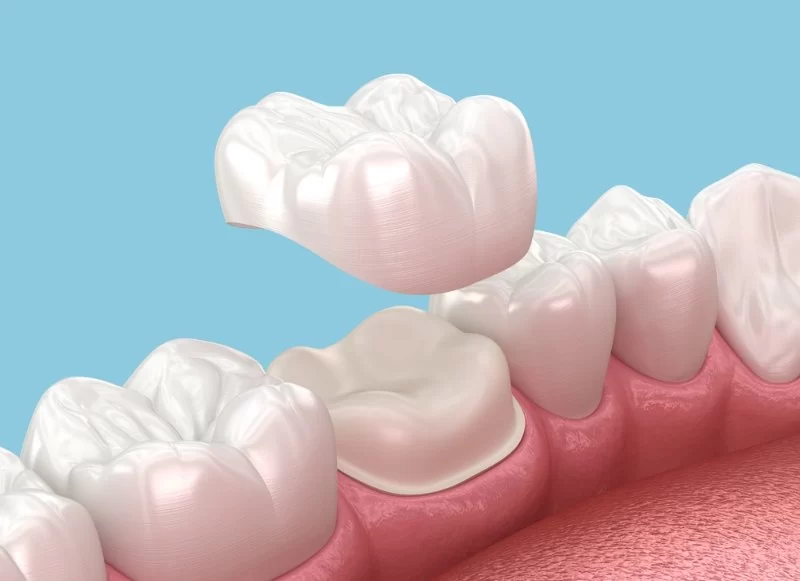 How to Care for Dental Crowns After Placement