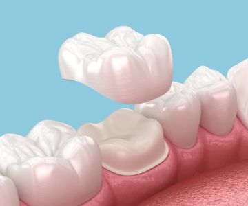 How to Care for Dental Crowns After Placement