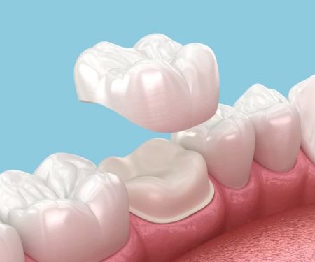 How to Care for Dental Crowns After Placement
