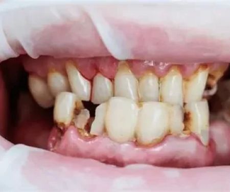 Why Do People Have Poor Oral Hygiene? Causes & Solutions Explained