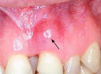 Signs of Tooth Abscess Infection and When to Seek Dental Care