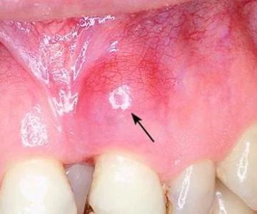Signs of Tooth Abscess Infection and When to Seek Dental Care