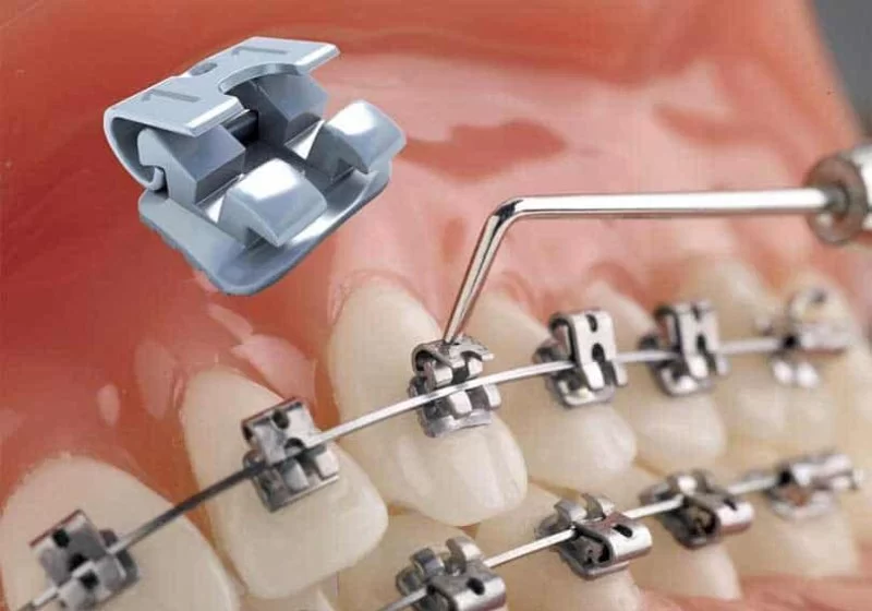 Does Brackets Fall for Bad Oral Hygiene? Orthodontic Care Explained