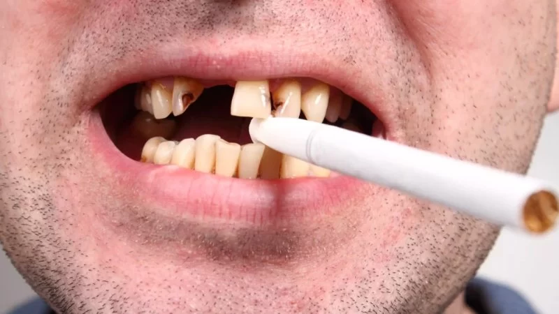 Oral Health Tips for Smokers: Practical Ways to Protect Your Smile