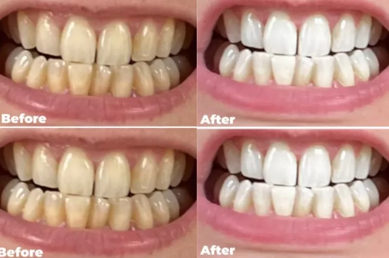 How to Whiten Teeth Without Damaging Enamel: Safe Methods and Tips