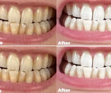 How to Whiten Teeth Without Damaging Enamel: Safe Methods and Tips