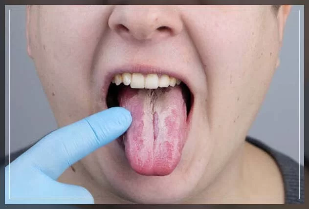 Signs of Oral Fungal Infection: Symptoms and Effective Treatment Options