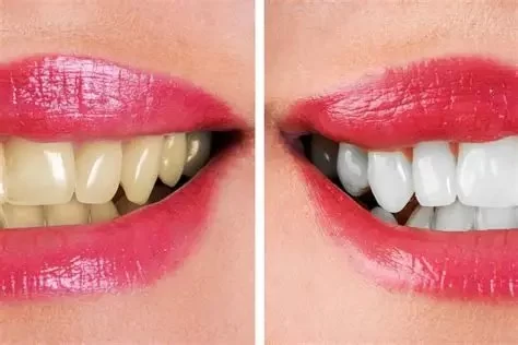 Best Foods to Avoid Tooth Staining for a Brighter Smile