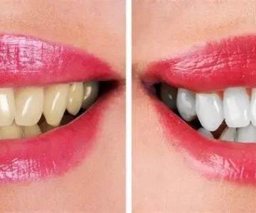 Best Foods to Avoid Tooth Staining for a Brighter Smile
