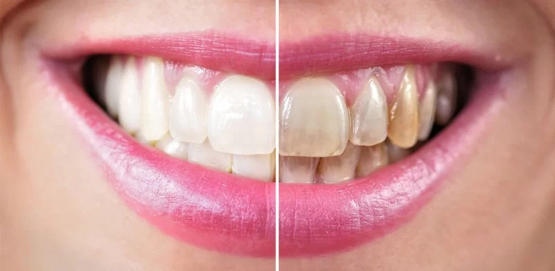 How to Whiten Teeth Without Damaging Enamel: Safe Whitening Tips and Professional Advice