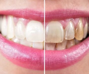 How to Whiten Teeth Without Damaging Enamel: Safe Whitening Tips and Professional Advice