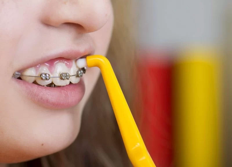 Oral Hygiene Tips for Children with Braces