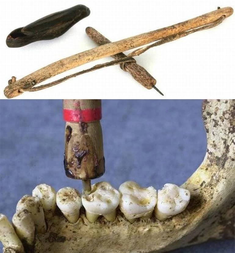 How Did Ancient People Keep Oral Hygiene – Early Dental Care and Natural Remedies