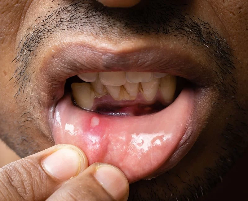 Does Bad Oral Hygiene Cause Mouth Ulcers?