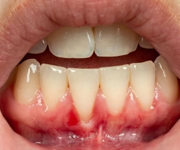 Key Signs of Receding Gums and How to Address Them Early