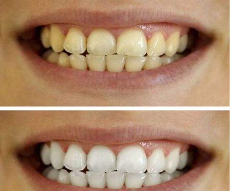 How to Whiten Teeth Using Natural Products Safely