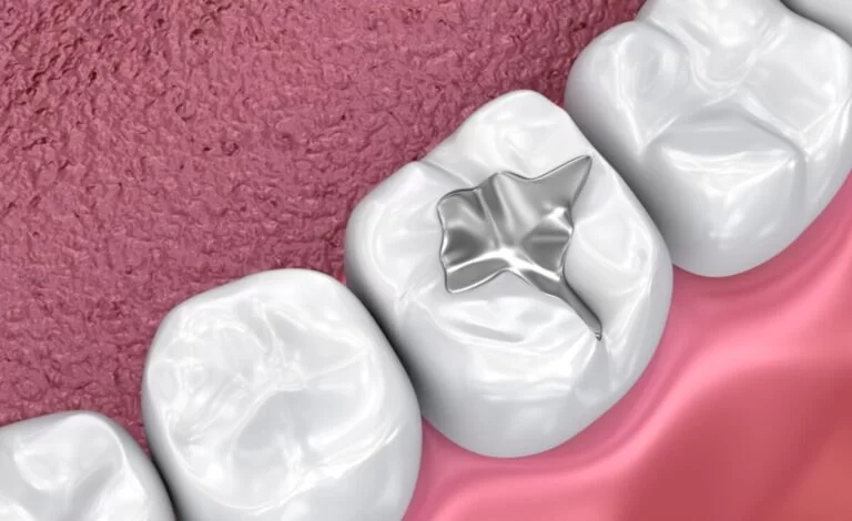 Dental Sealants Benefits: What They Do and Why They Matter