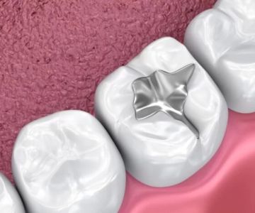 Dental Sealants Benefits: What They Do and Why They Matter
