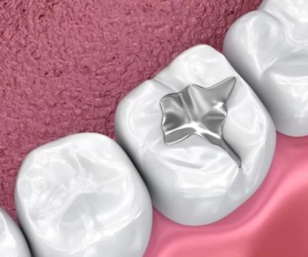 Dental Sealants Benefits: What They Do and Why They Matter